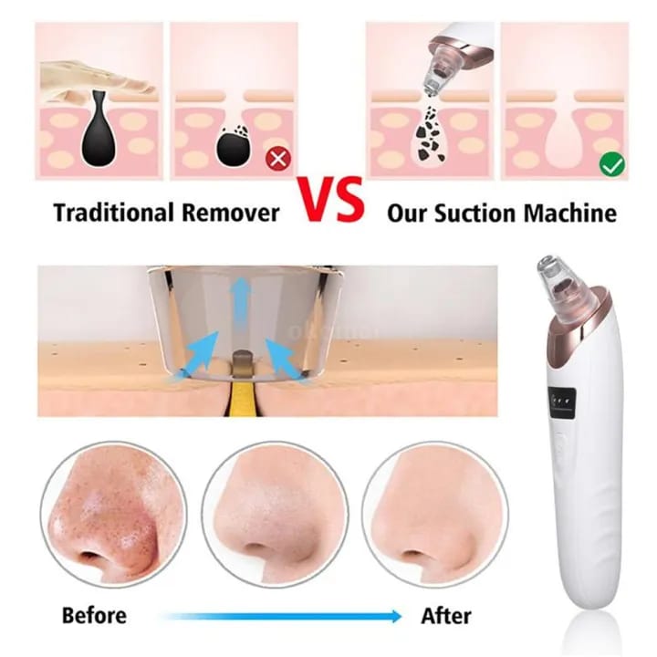 Professional Blackhead Suction Remover | Deep Cleansing Pore Vacuum for Face & Nose